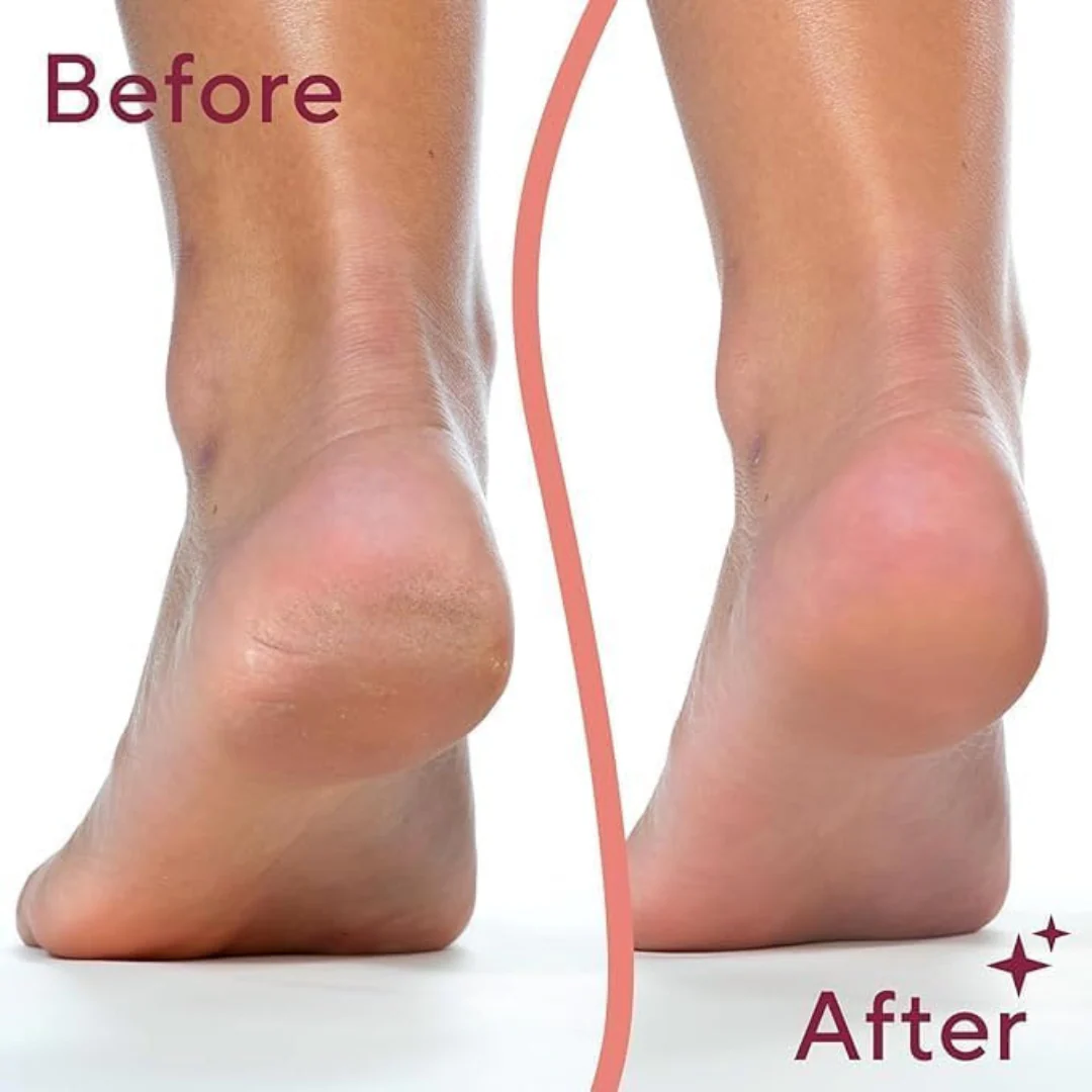 GlowStep - Callus Remover For Feet