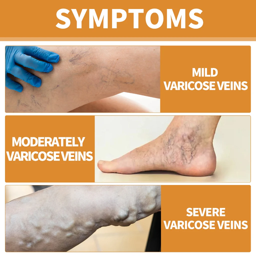 Turmeric Varicose Vein Relief Spray( BUY 1 GET 2 FREE💥 🎁 )
