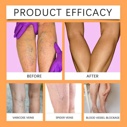 Turmeric Varicose Vein Relief Spray( BUY 1 GET 2 FREE💥 🎁 )