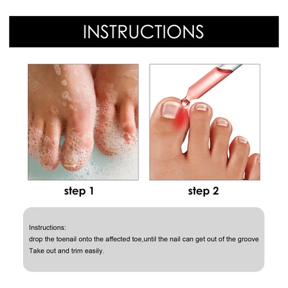 SouthMoon Ingrown Toenail Drops Nail Fungal Repair( BUY 1 GET 1 FREE)