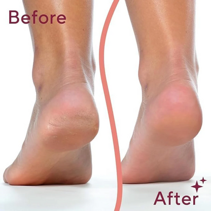 GlowStep - Callus Remover For Feet